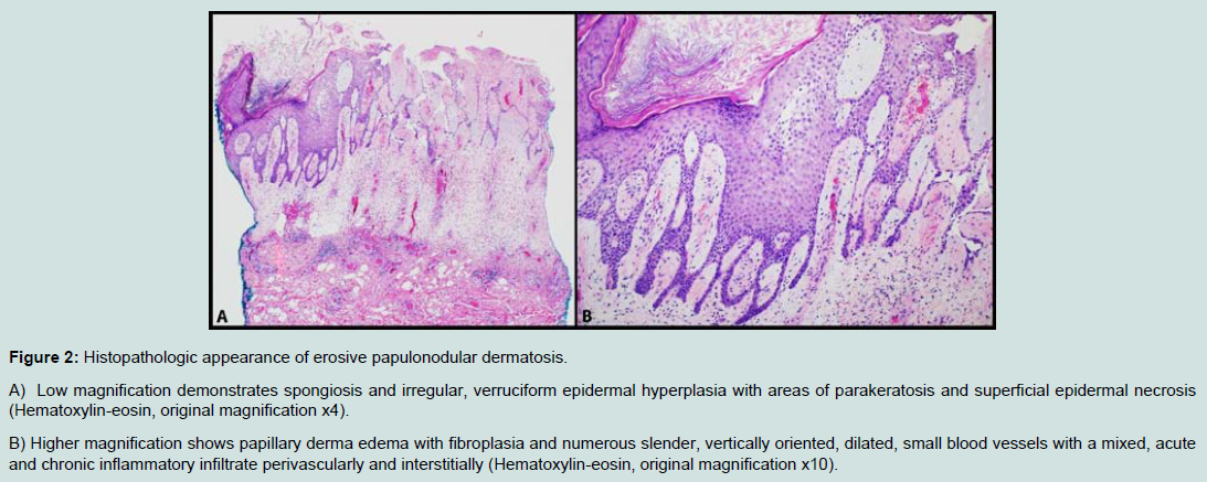Avens Publishing Group - Erosive Papulonodular Dermatosis of the Lower ...